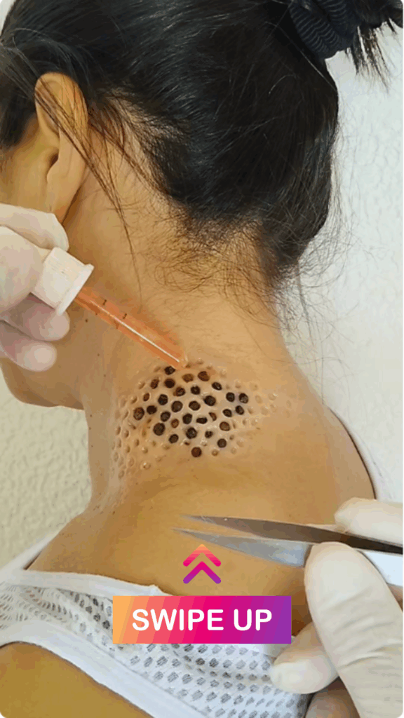 Is There a Recently Discovered Lethal Insect Species that Creates Multiple Small Holes in Palms?