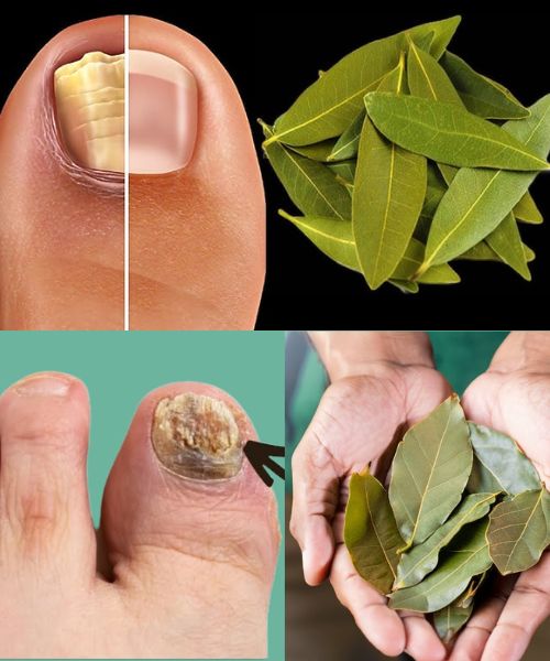 Eliminate Nail Fungus Naturally with Bay Leaves…