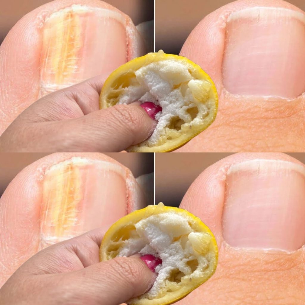 Home Remedies To Get Rid Of Scalp Fungus & Prevention Tips…