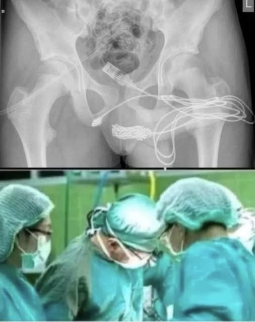 Girl was hospitalized for trying one more pen…See more