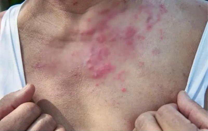 A stress-related illness almost no one talks about — but you should know