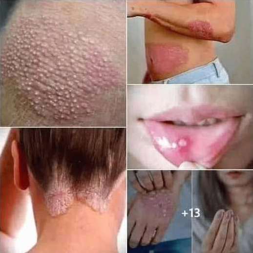 Signs of Human Papillomavirus You Should Know: What Your Body Might Be Telling You