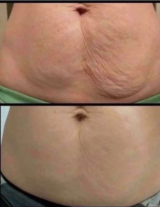 How to Firm Sagging Skin Naturally: 9 Effective Home Remedies